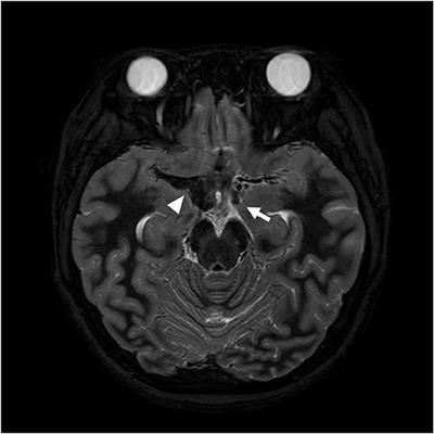 Diffuse Cerebral Vasospasm After Aneurysmal Subarachnoid Hemorrhage in a 15-Year-Old Girl: A Case Report